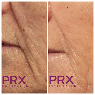 Signaturbehandling med Microneedling og PRX-T33